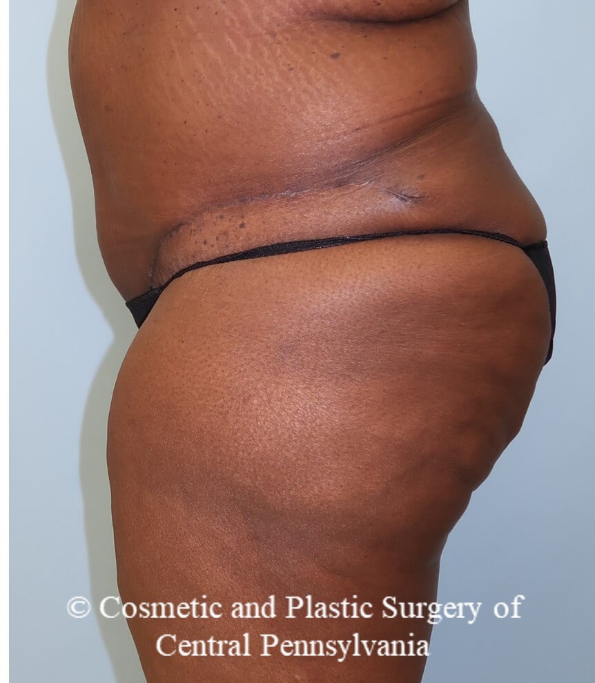 Tummy Tuck After