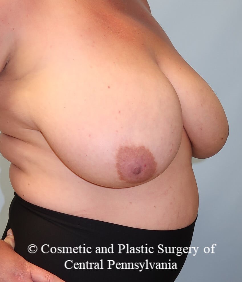 Breast Reduction Before