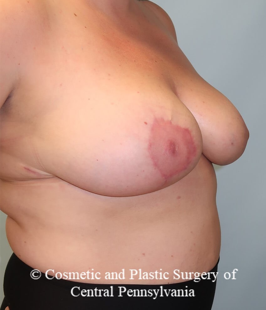 Breast Reduction After