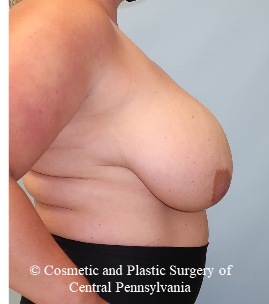 Breast Reduction Before