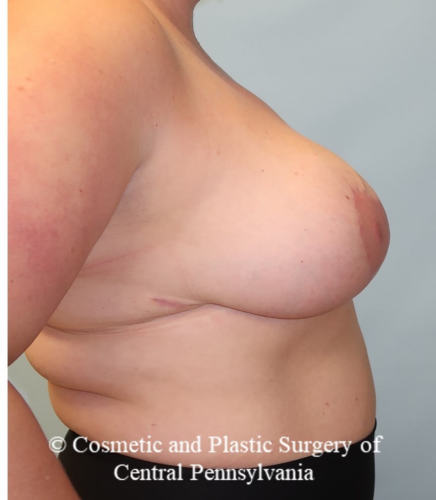 Breast Reduction After