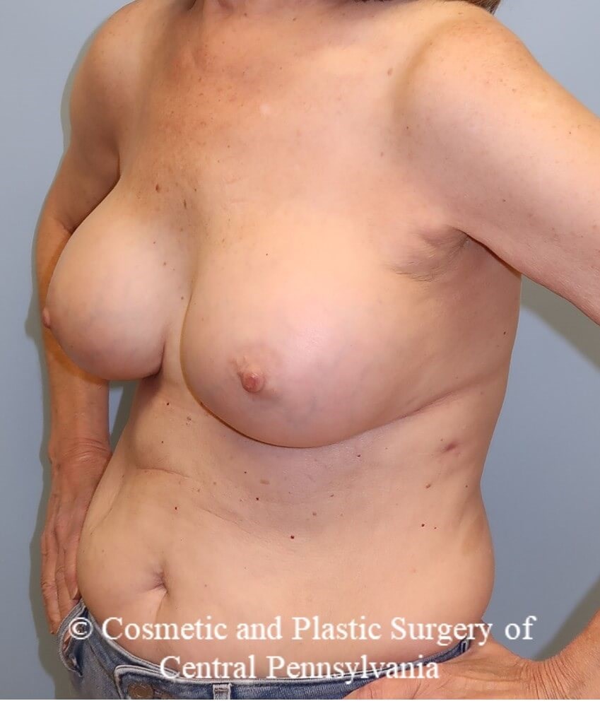 Breast Augmentation Revision After