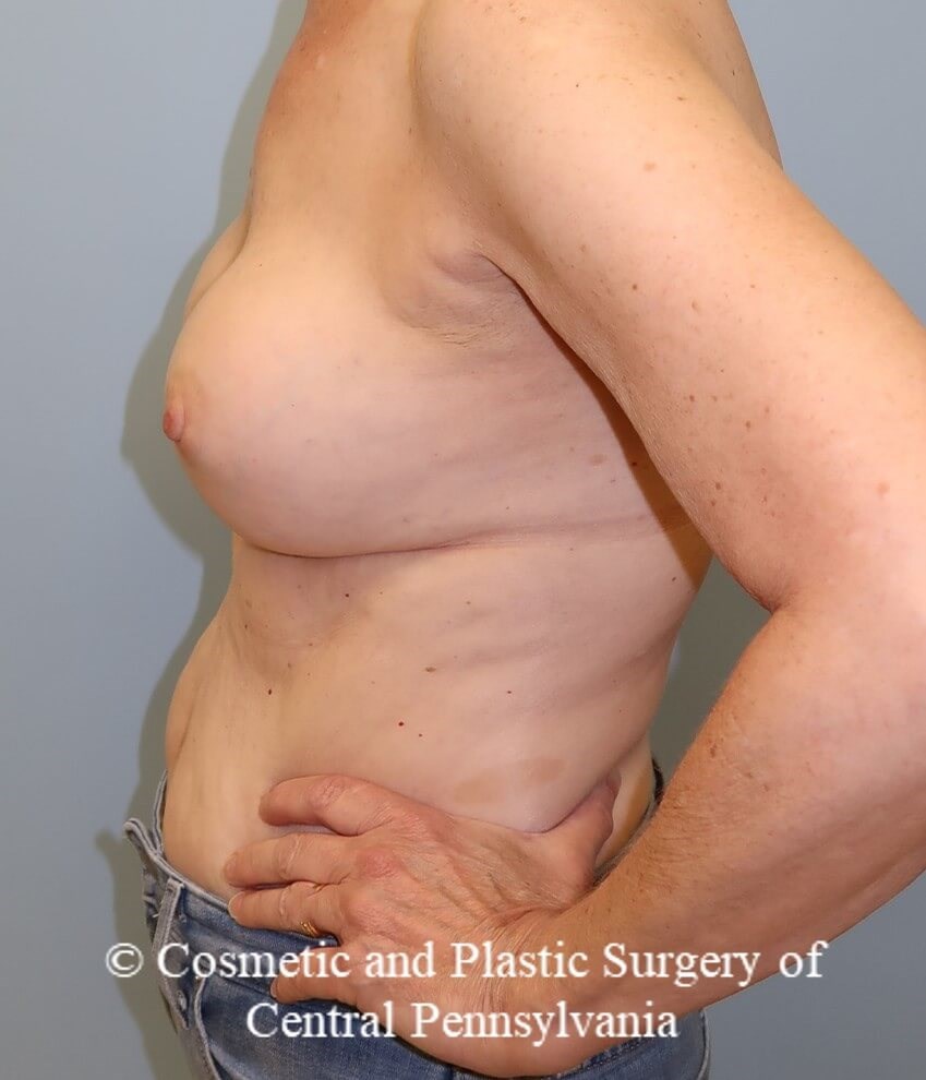 Breast Augmentation Revision Before