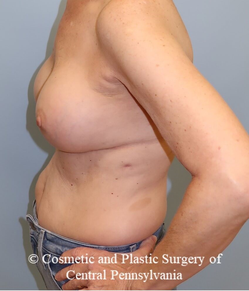 Breast Augmentation Revision After