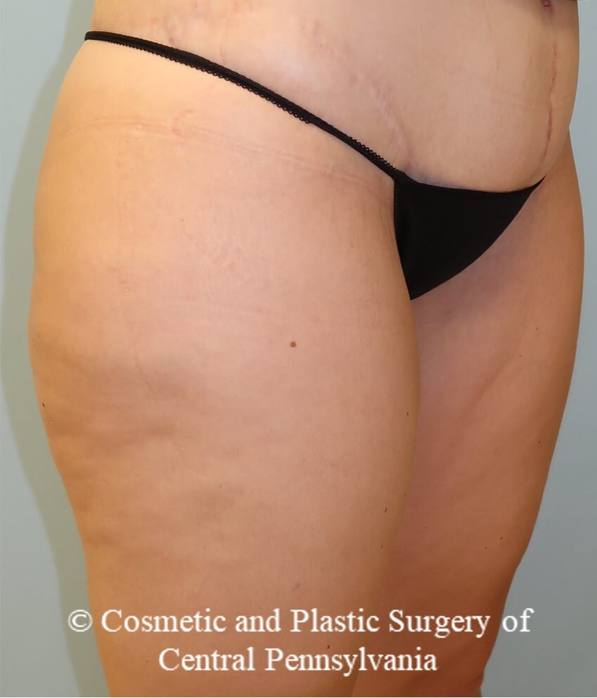 Thigh Lift Before