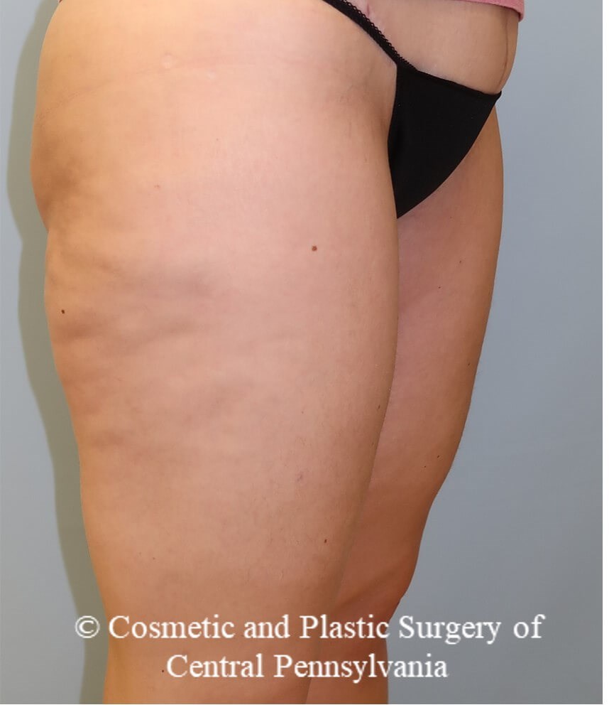 Thigh Lift After