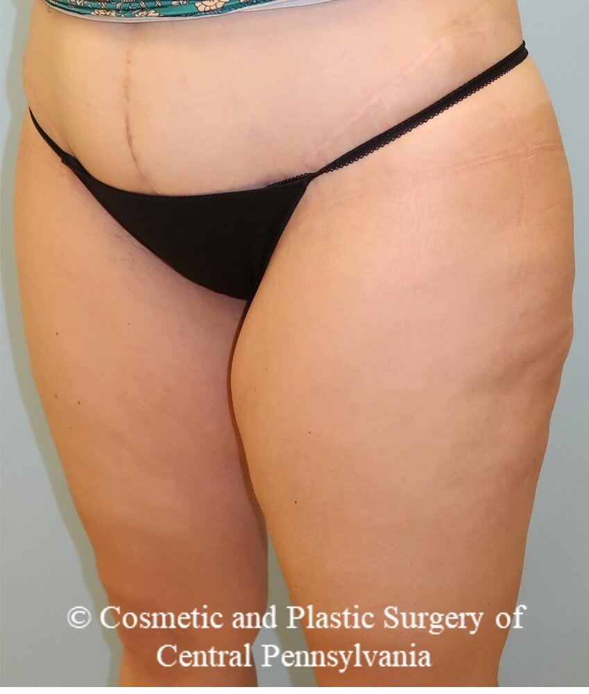 Thigh Lift Before