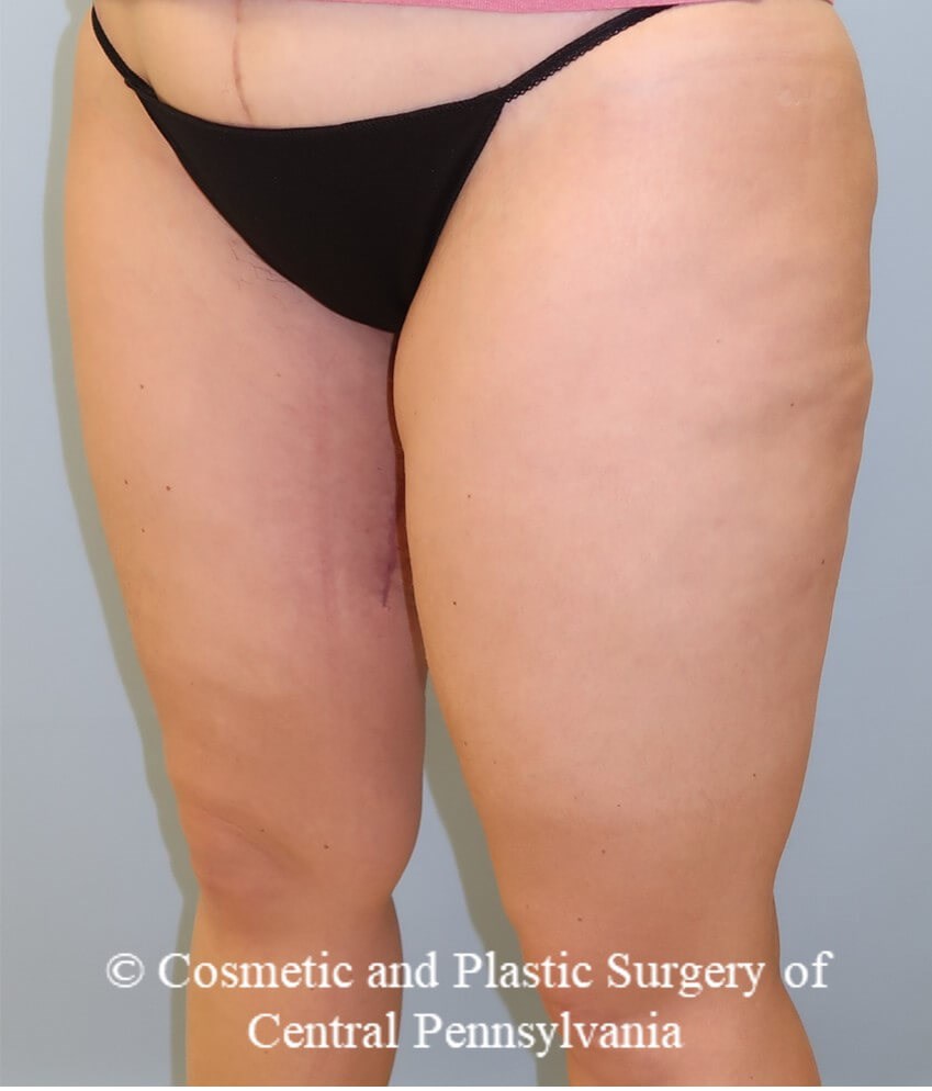 Thigh Lift After