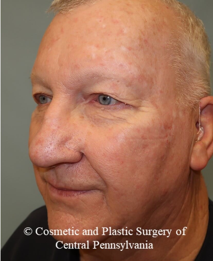 Blepharoplasty (upper eyelid) Before