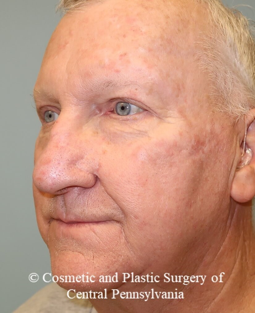 Blepharoplasty (upper eyelid) After