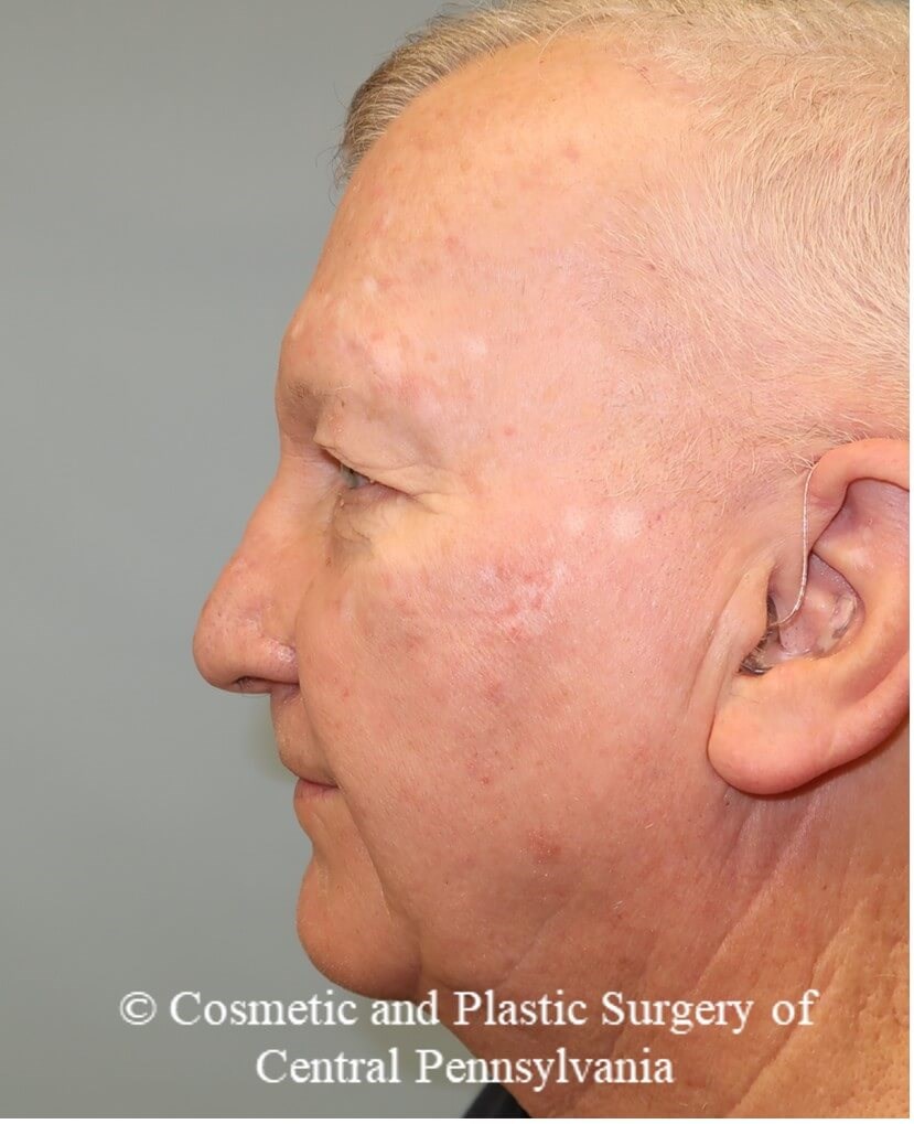 Blepharoplasty (upper eyelid) Before