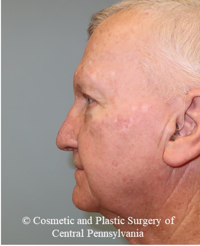 Blepharoplasty (upper eyelid) After