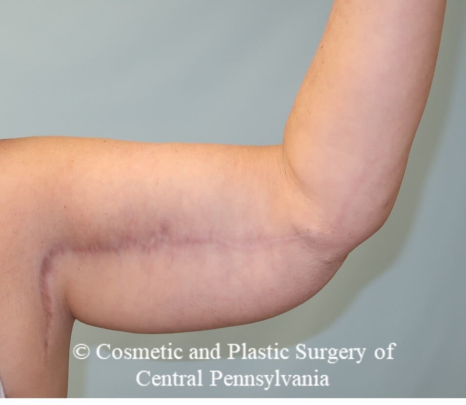 Brachioplasty (arm lift) After