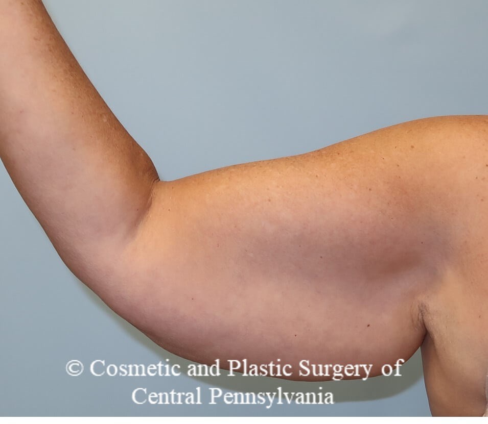 Brachioplasty (arm lift) Before