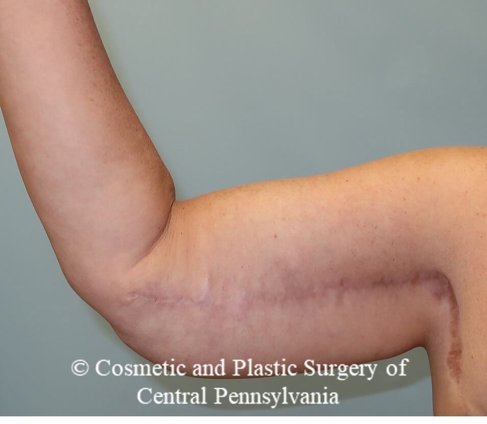 Brachioplasty (arm lift) After