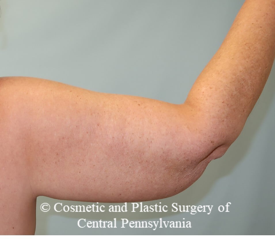 Brachioplasty (arm lift) After
