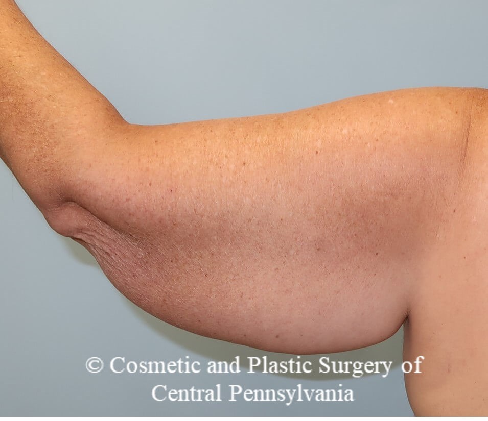 Brachioplasty (arm lift) Before