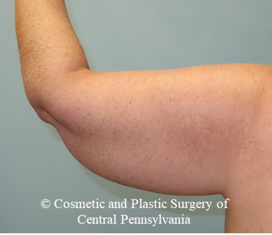 Brachioplasty (arm lift) After