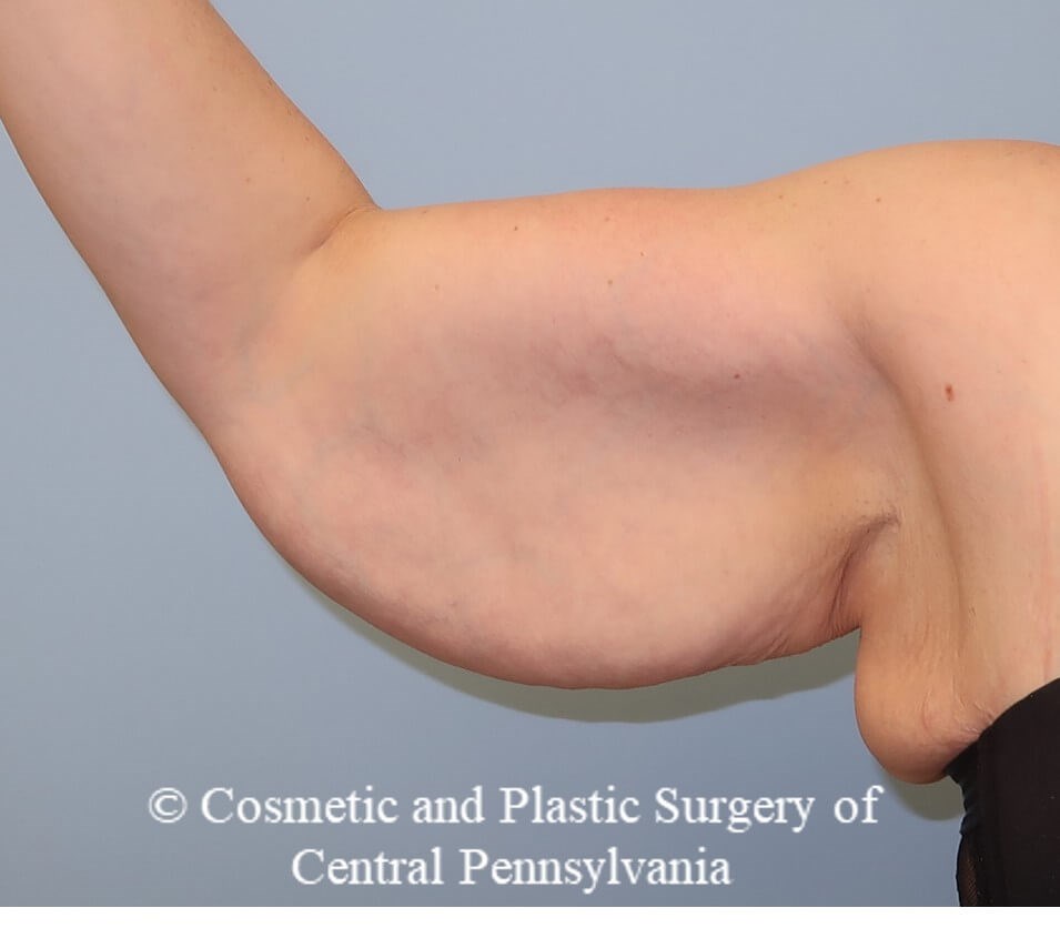 Brachioplasty (arm lift) Before
