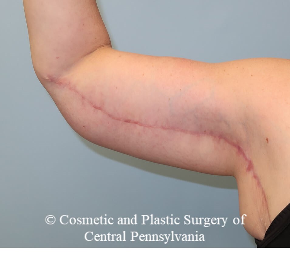 Brachioplasty (arm lift) After