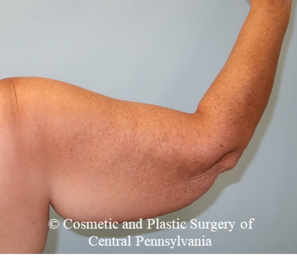 Brachioplasty (arm lift) Before