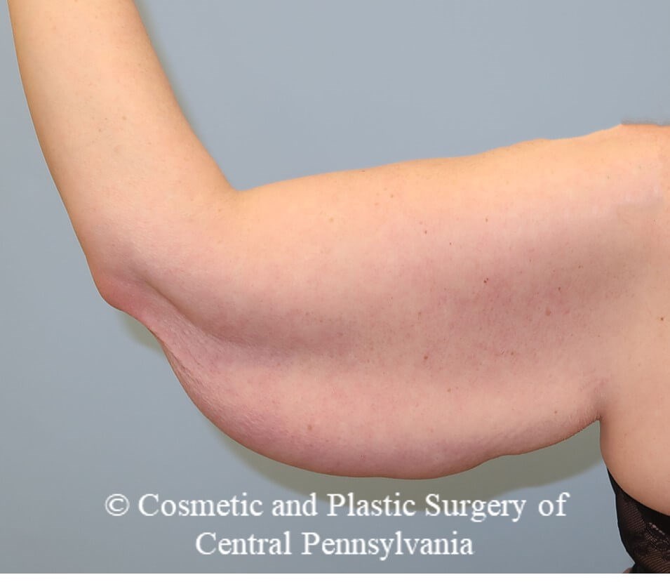 Brachioplasty (arm lift) Before