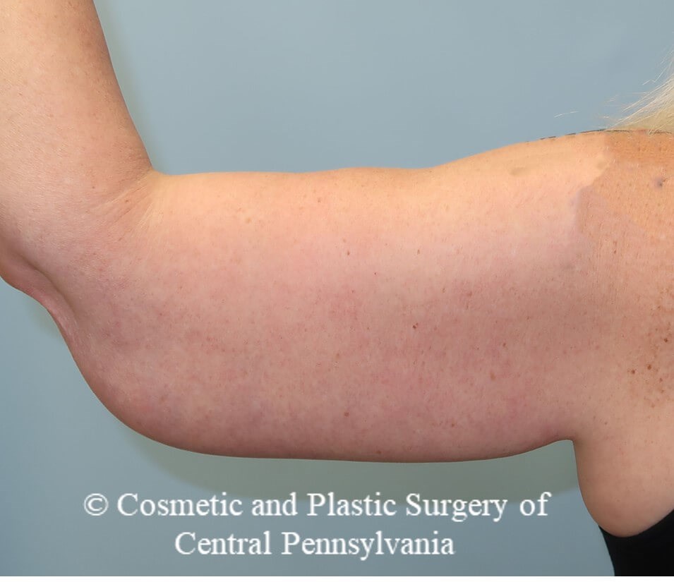 Brachioplasty (arm lift) After