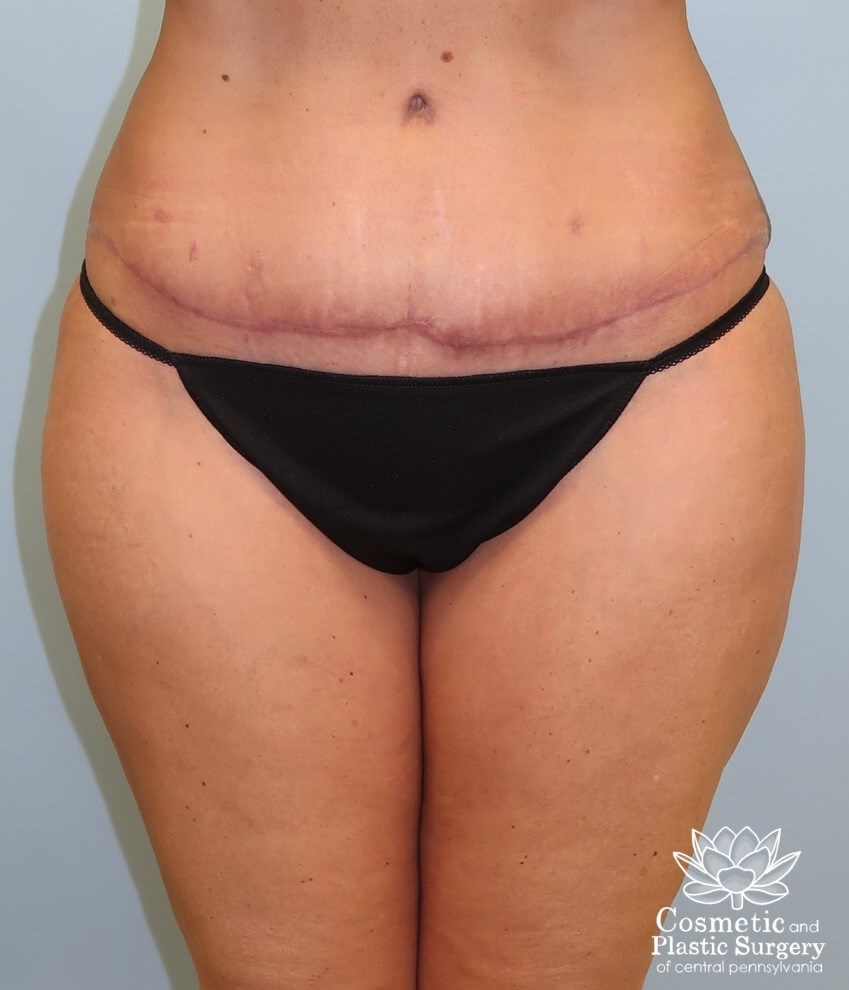 Abdominoplasty (Tummy Tuck) After