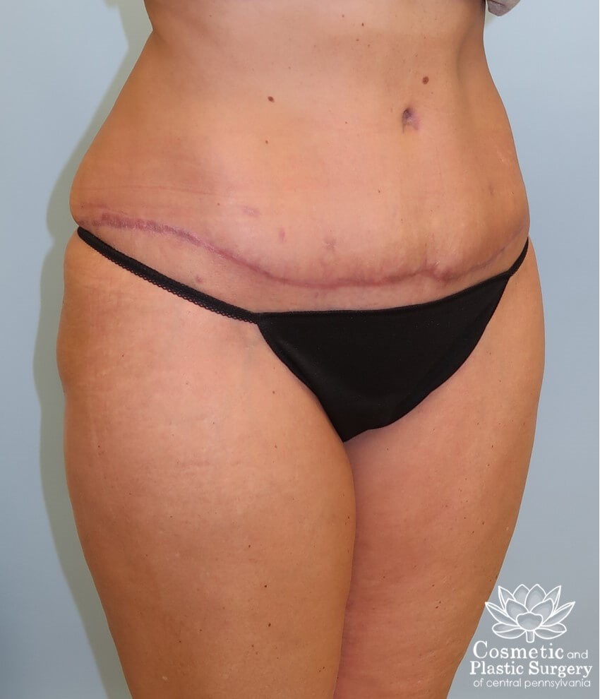 Abdominoplasty (Tummy Tuck) After
