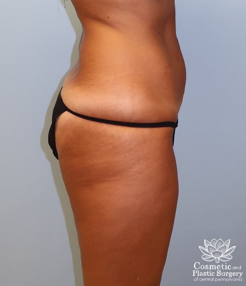 Abdominoplasty (Tummy Tuck) Before