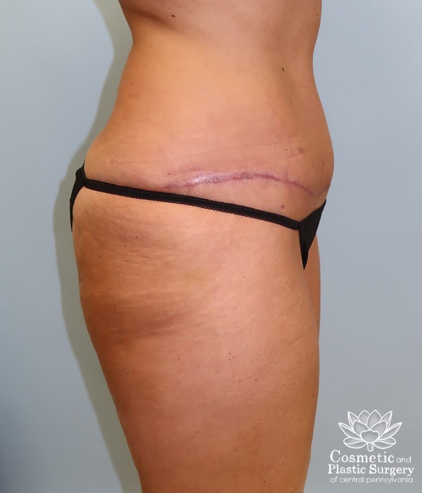 Abdominoplasty (Tummy Tuck) After