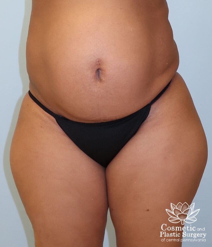 Tummy Tuck Before