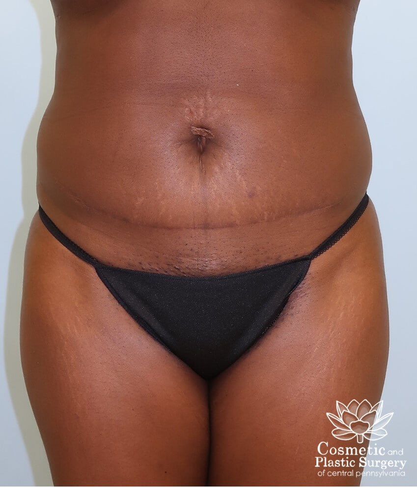 Liposuction Before