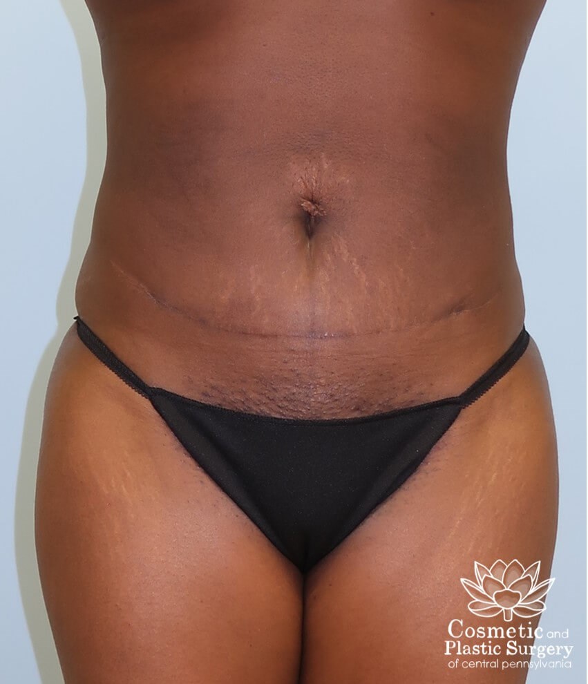 Liposuction After