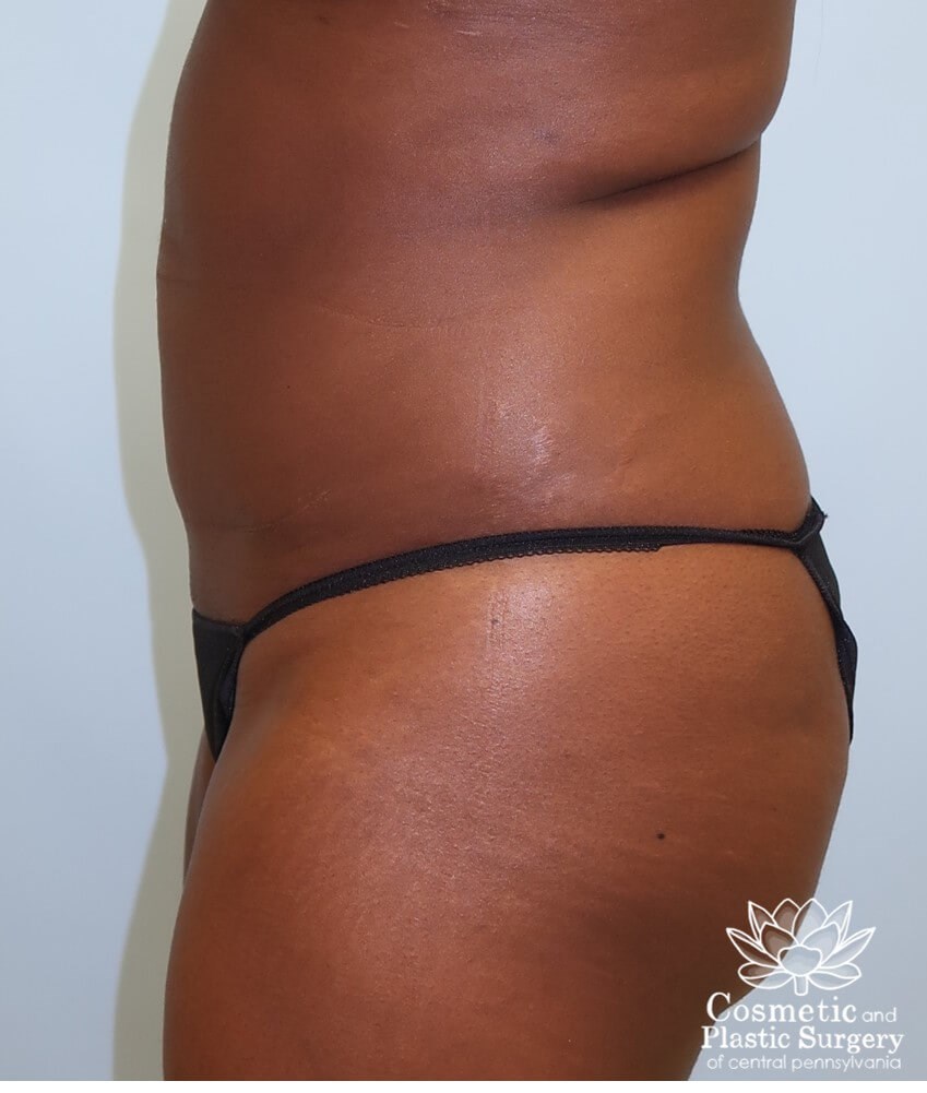 Liposuction Before