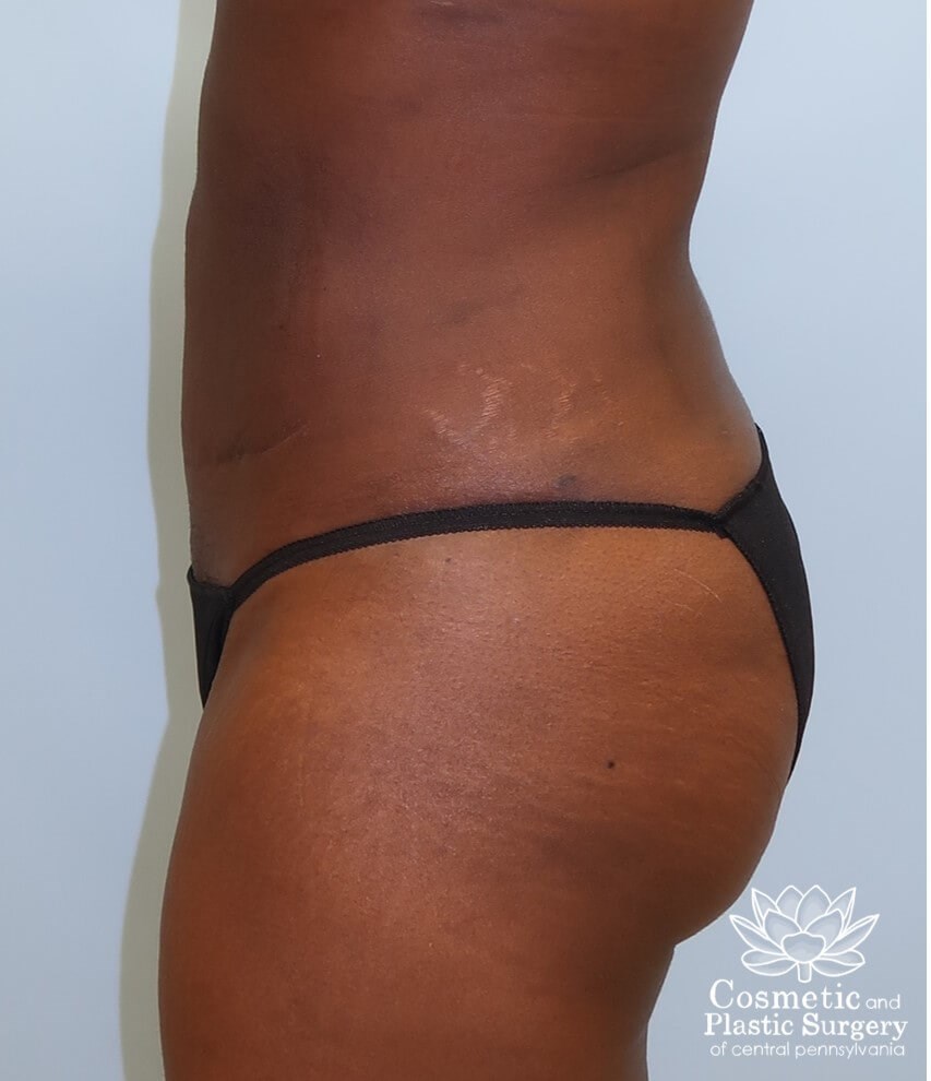 Liposuction After