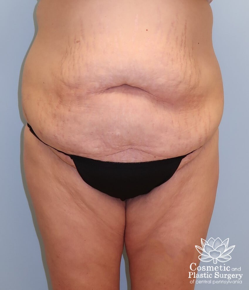 Tummy Tuck Before