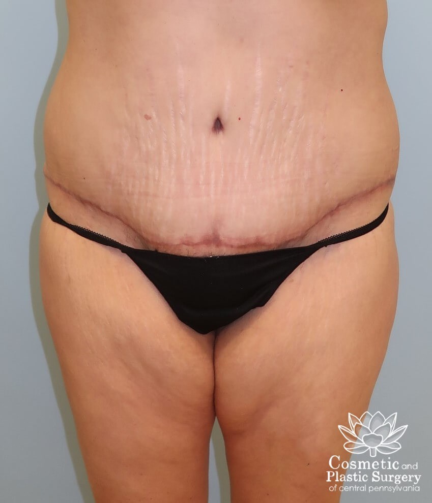 Tummy Tuck After