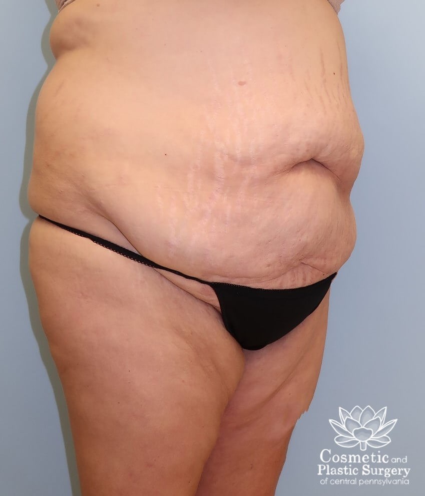 Tummy Tuck Before