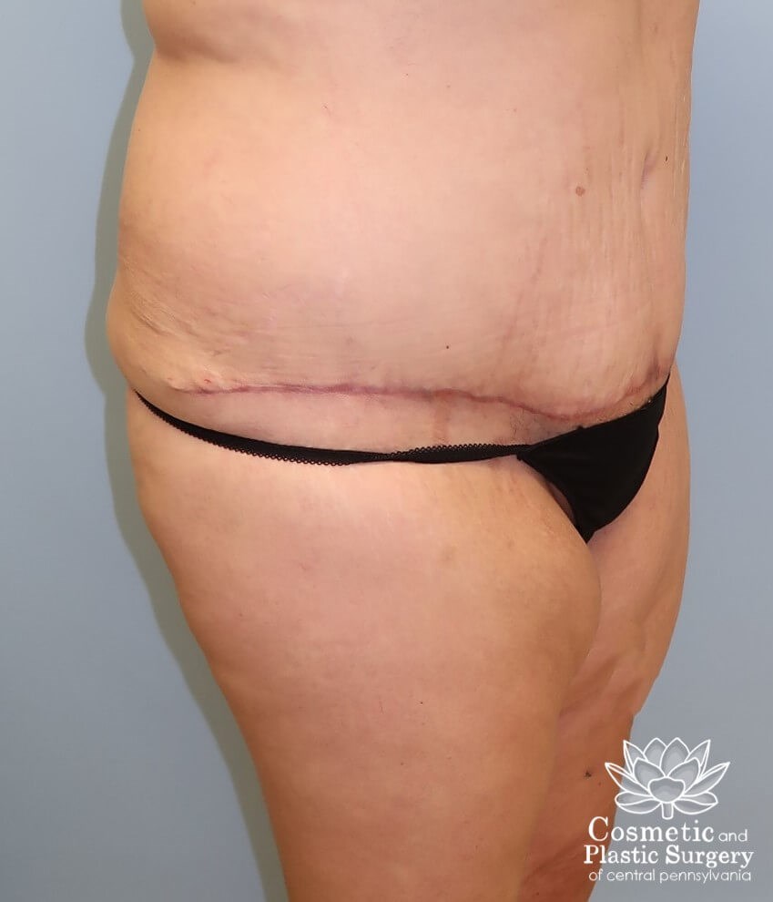 Tummy Tuck After