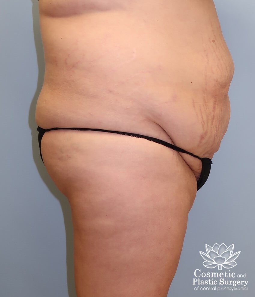 Tummy Tuck Before