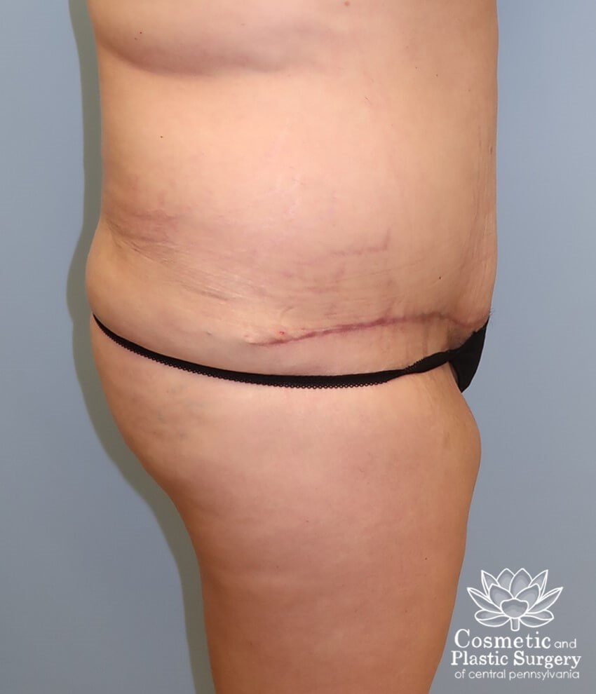 Tummy Tuck After