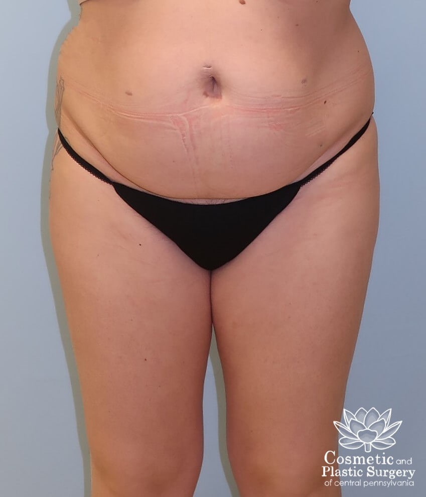 Tummy Tuck Before
