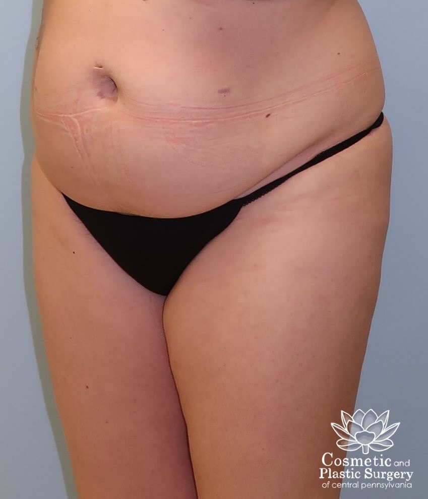 Tummy Tuck Before