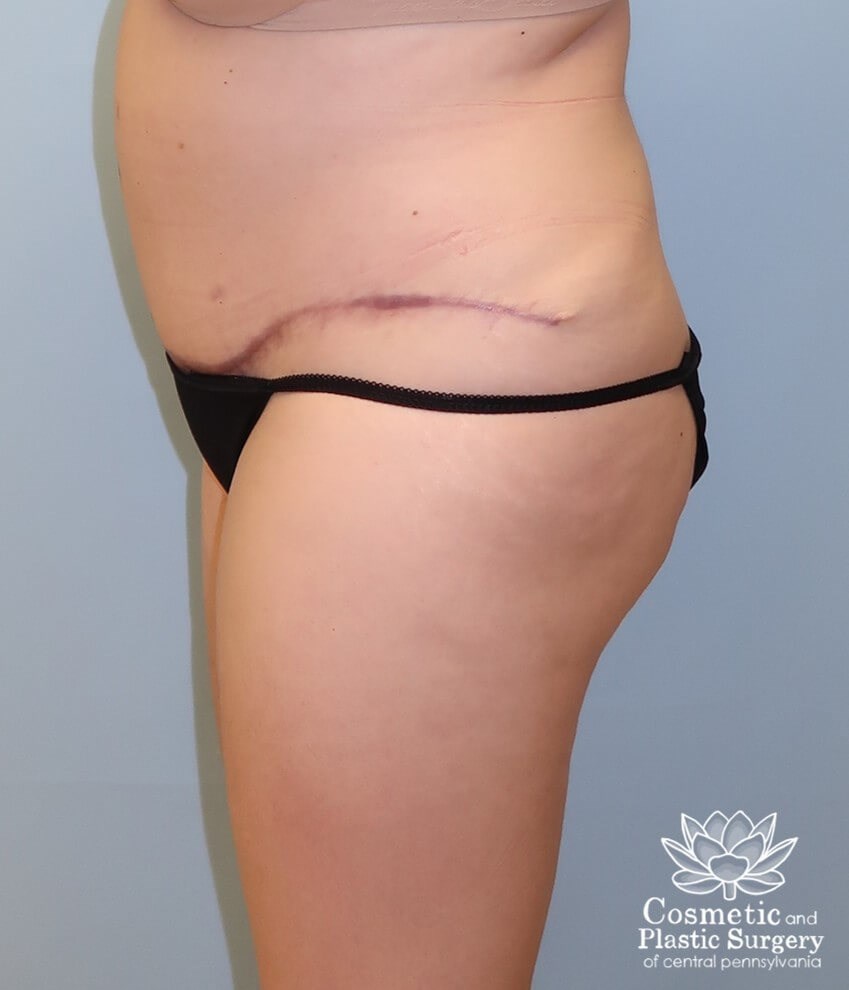 Tummy Tuck After