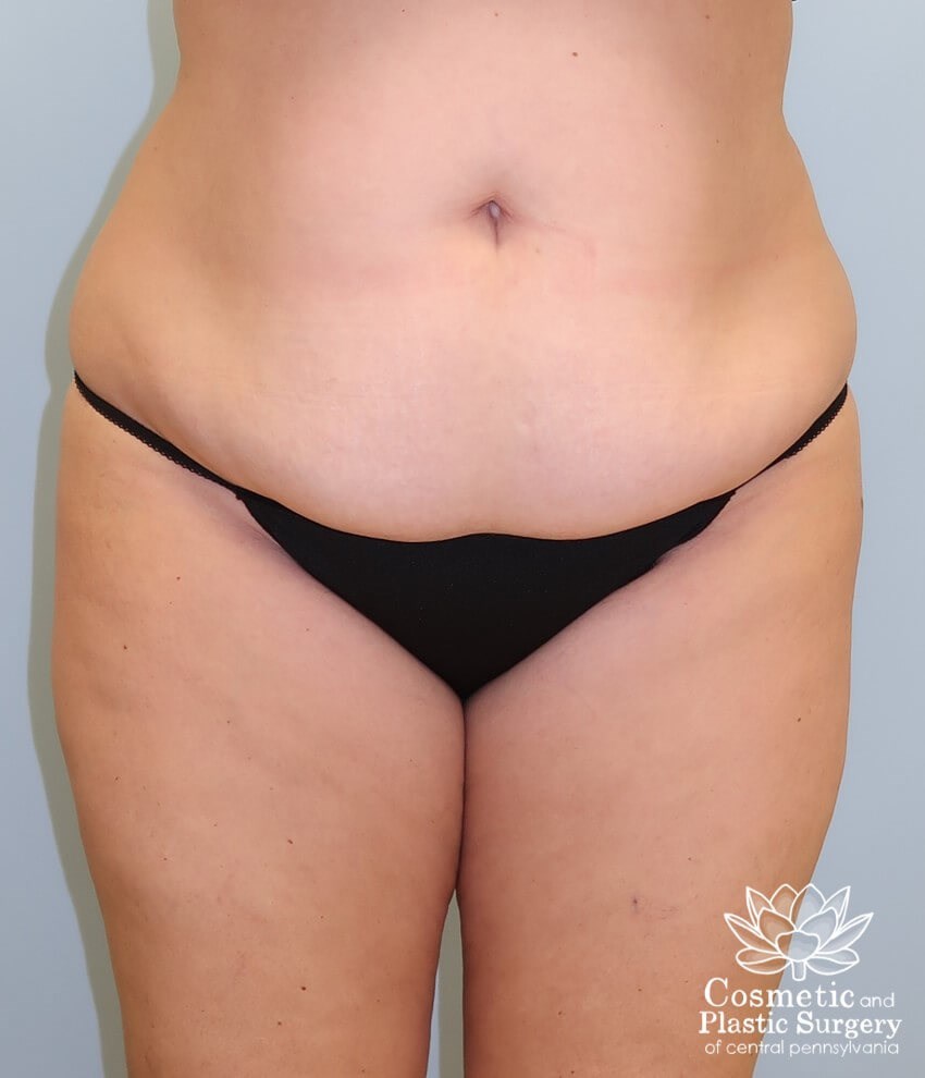 Abdominoplasty (Tummy Tuck) Before