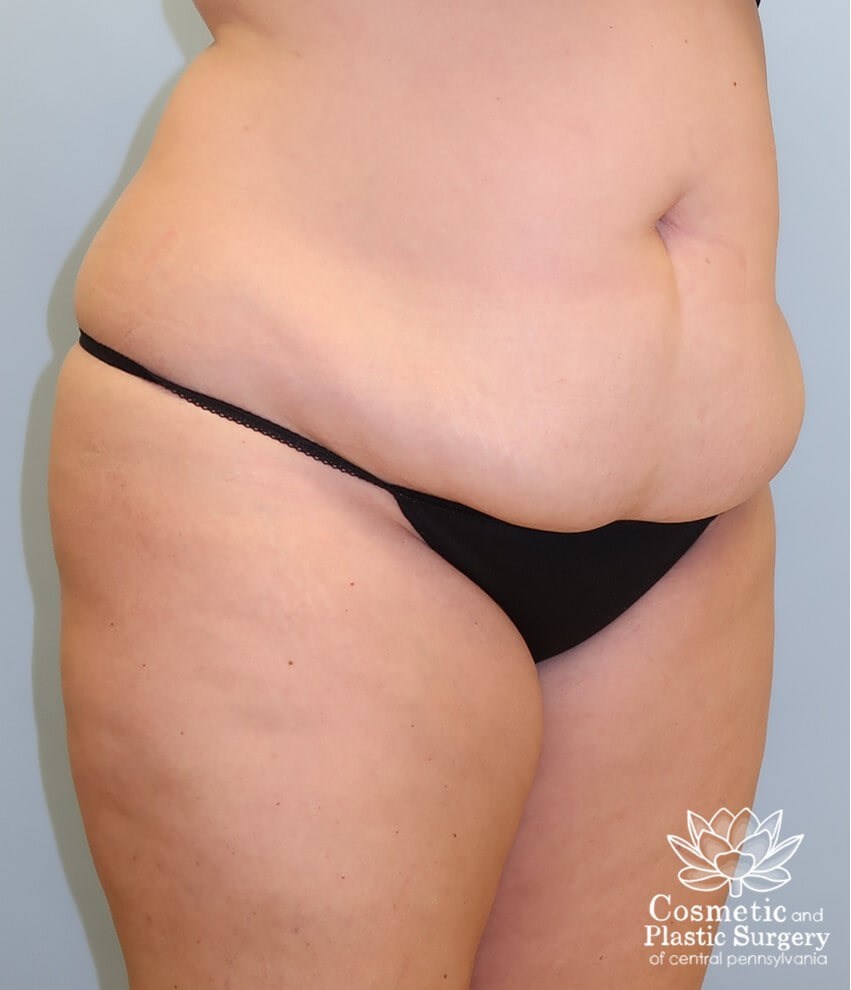 Abdominoplasty (Tummy Tuck) Before