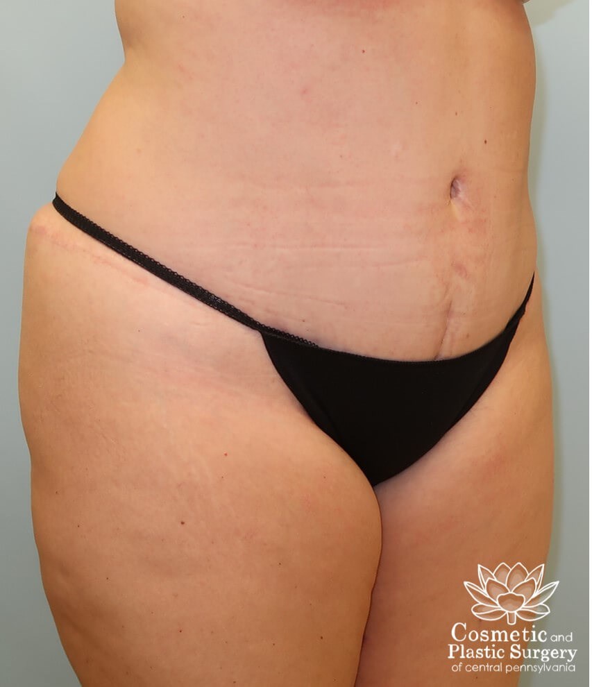 Abdominoplasty (Tummy Tuck) After