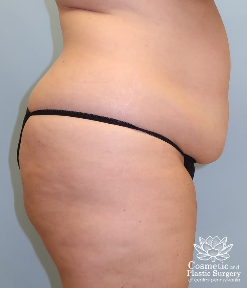 Abdominoplasty (Tummy Tuck) Before