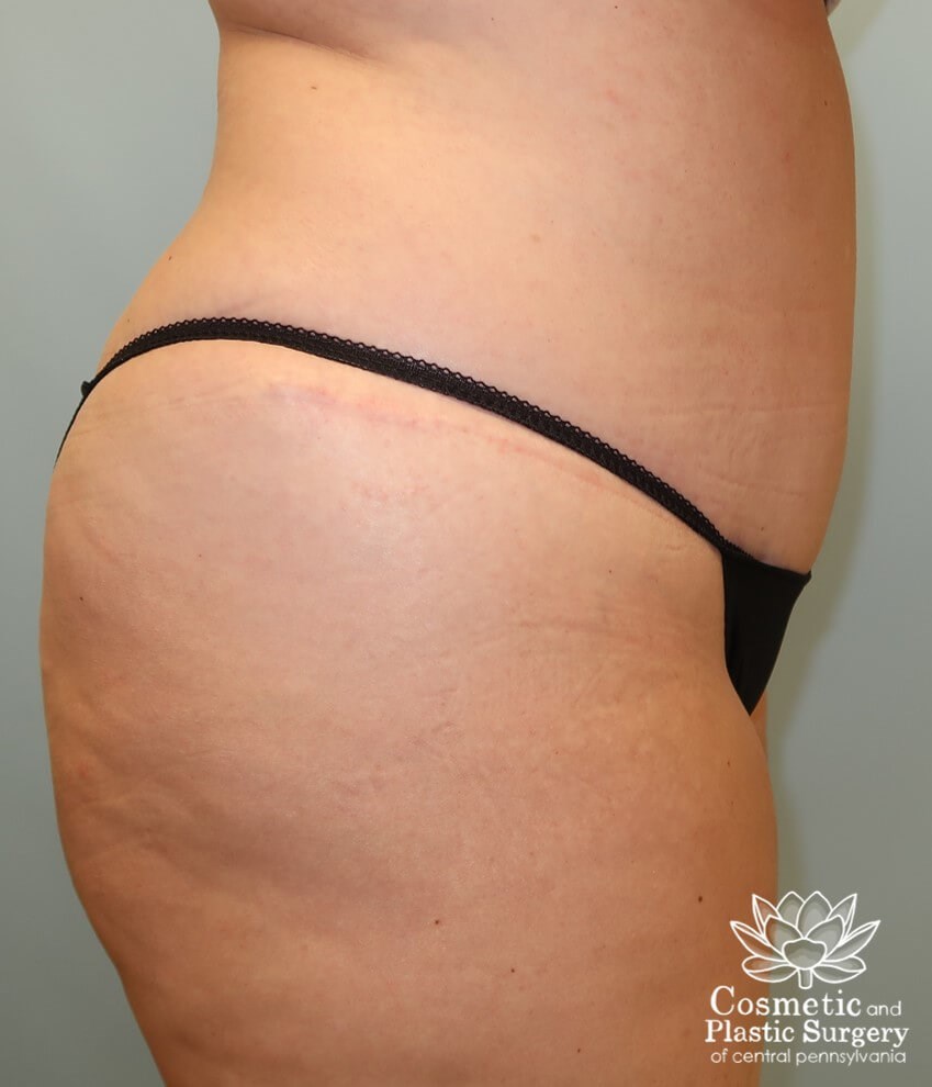Abdominoplasty (Tummy Tuck) After